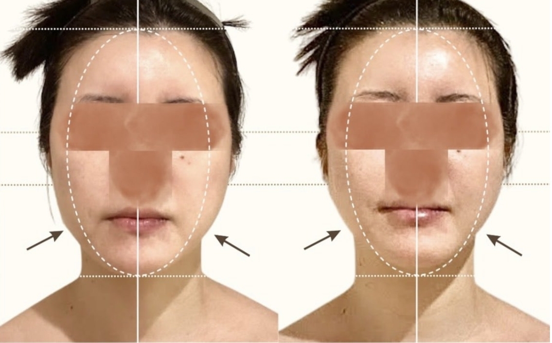 美禅の施術前後の画像