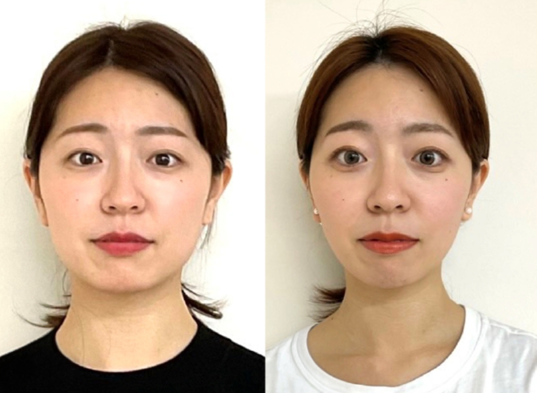 美禅の施術前後の画像